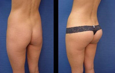 buttocks augmentation before and after