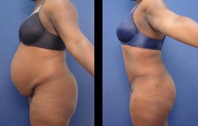 buttocks augmentation clarified before and after