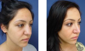 Rhinoplasty Plastic Surgeon Orange County