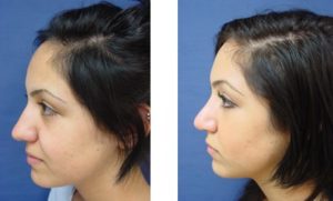 rhinoplasty procedure - left view