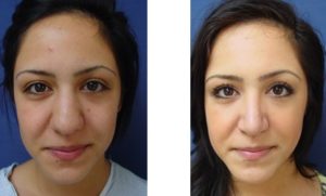 Rhinoplasty Plastic Surgeon Orange County