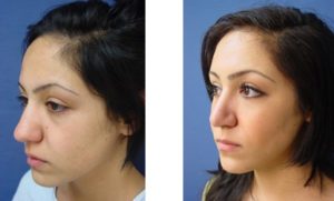 Rhinoplasty Plastic Surgeon Orange County