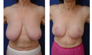 Breast Lift Plastic Surgeon Orange County