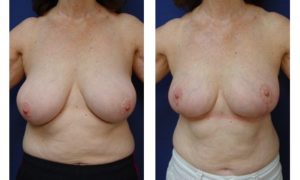 Breast Lift Plastic Surgeon Orange County