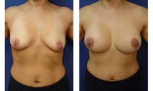 Breast Lift Plastic Surgeon Orange County