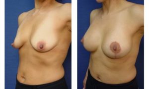 Breast Lift Plastic Surgeon Orange County