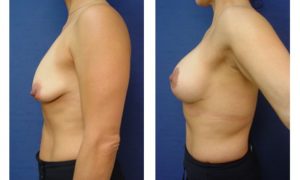 Breast Lift Plastic Surgeon Orange County