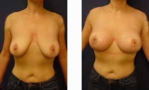 Breast Lift Plastic Surgeon Orange County