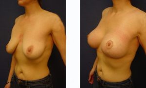 Breast Lift Plastic Surgeon Orange County