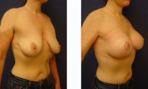 Breast Lift Plastic Surgeon Orange County