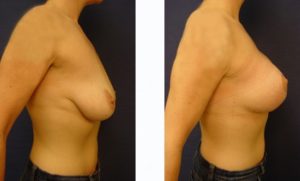 Breast Lift Plastic Surgeon Orange County