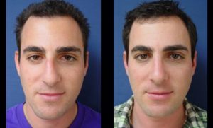 Rhinoplasty Plastic Surgeon Orange County