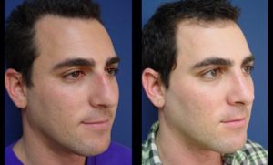 Rhinoplasty Plastic Surgeon Orange County