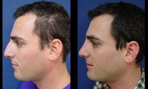 Rhinoplasty Plastic Surgeon Orange County