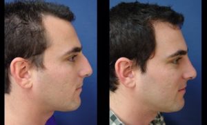 Rhinoplasty Plastic Surgeon Orange County