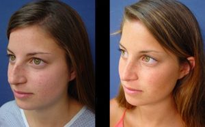 Rhinoplasty Plastic Surgeon Orange County