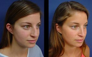 Rhinoplasty Plastic Surgeon Orange County