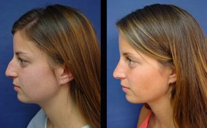 Rhinoplasty Plastic Surgeon Orange County