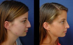 Rhinoplasty Plastic Surgeon Orange County