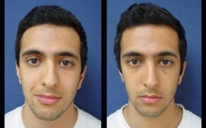 Rhinoplasty Plastic Surgeon Orange County