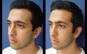 Rhinoplasty Plastic Surgeon Orange County