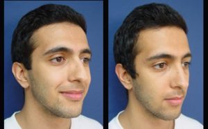 Rhinoplasty Plastic Surgeon Orange County