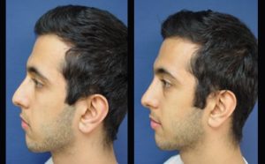 Rhinoplasty Plastic Surgeon Orange County