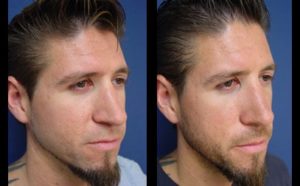 Rhinoplasty Plastic Surgeon Orange County