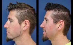 Rhinoplasty Plastic Surgeon Orange County