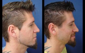 Rhinoplasty Plastic Surgeon Orange County