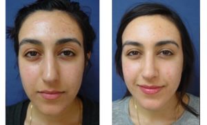 Rhinoplasty Plastic Surgeon Orange County