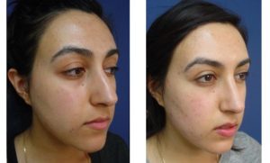 Rhinoplasty Plastic Surgeon Orange County