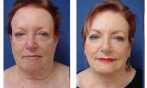 Facelift Plastic Surgeon Orange County