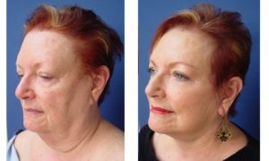 Facelift Plastic Surgeon Orange County