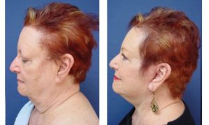 Facelift Plastic Surgeon Orange County