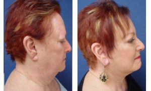 Facelift Plastic Surgeon Orange County