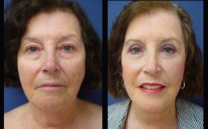 Face lift Plastic Surgeon Orange County