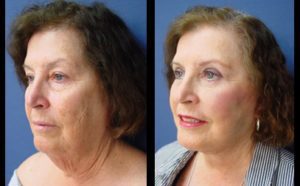 Face lift Plastic Surgeon Orange County