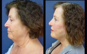 Face lift Plastic Surgeon Orange County