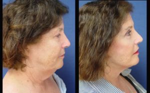 face and neck lift - right view