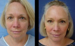 Facelift Plastic Surgeon Orange County