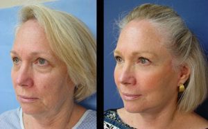 Facelift Plastic Surgeon Orange County