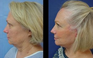 Facelift Plastic Surgeon Orange County