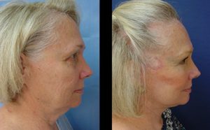 Facelift Plastic Surgeon Orange County