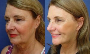 Rhinoplasty Plastic Surgeon Orange County