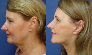 Rhinoplasty Plastic Surgeon Orange County