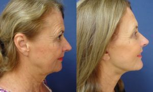 Rhinoplasty Plastic Surgeon Orange County