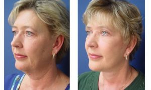 Rhinoplasty Plastic Surgeon Orange County