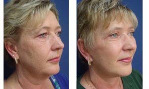 Rhinoplasty Plastic Surgeon Orange County