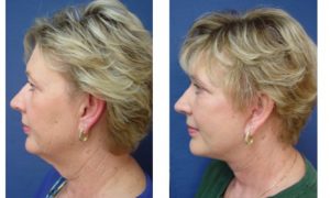 Rhinoplasty Plastic Surgeon Orange County